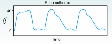 An infant demonstrates the following capnogram while being mechanically ventilated.   How should the therapist interpret this capnogram? A) The patient has received a paralytic agent. B) A paralytic agent is indicated for this patient because of the spontaneous breathing efforts represented by the downward deflections. C) The patient may have developed a pneumothorax. D) A leak has developed in the patient-ventilator system.