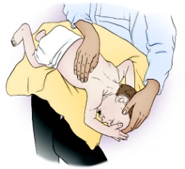 On the basis of the following diagram,which of the following lung segments is being drained?   A) Posterior segment of the right upper lobe B) Apical segment of the right upper lobe C) Posterior basal segments of both lower lobes D) Anterior segments of both upper lobes