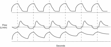 On the basis of the following flow/time scalar,which of the following conditions has developed?   A) Trigger dyssynchrony B) Excess tidal volume C) Air trapping D) Ventilator circuit leak