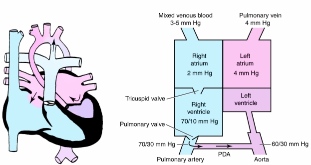 Identify the congenital cardiac defect depicted in the following illustration:   A) Atrial septal defect B) Hypoplastic left ventricular syndrome C) Hypoplastic right ventricular syndrome D) Atrioventricular canal defect