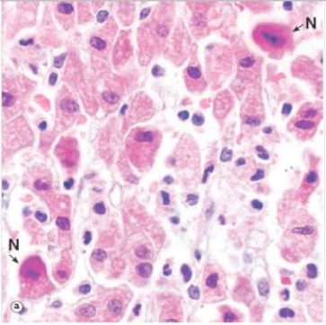 The nuclei in the liver cells designated with an  N  in the accompanying photomicrograph appear abnormal.Which one of the following terms best describes their appearance?   A) Acidophilic B) Eosinophilic C) Vacuolated D) Karyolytic E) Pyknotic