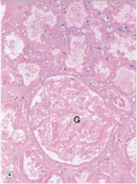 A renal glomerulus (G) and surrounding tubules are shown in the accompanying photomicrograph.Which one of the following is the best description of the histopathology seen?   A) Absence of nuclei B) Acute inflammation C) Caseation necrosis D) Dissolution of underlying organ structure E) Pyknosis