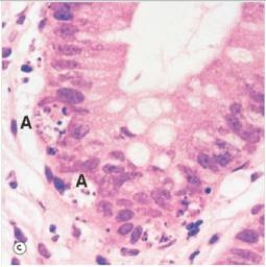 The structure labelled  A  in the accompanying photomicrograph of colonic mucosa represents which one of the following processes?   A) Apoptosis B) Metaplasia C) Mitosis D) Necrosis E) Neoplasia