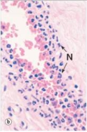 The neutrophils (N) in the accompanying photomicrograph are attracted to their extravascular location primarily by which one of the following factors?   A) C3a B) C5a C) C5b D) Collagen E) Fibrin  F) Neutrophil chemotactic factor