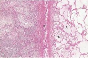 In the accompanying low power photomicrograph of lung,the interlobar fissure,labelled  F ,conveniently divides the lung in half.The end result of the pathologic process seen on the left- hand side,if properly treated with appropriate antimicrobials,would normally be which one of the following?   A) Complete resolution B) Dysplasia C) Neoplastic change D) Pulmonary oedema E) Scarring