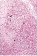 In the accompanying high power photomicrograph of lung,the alveolar capillary is marked  C .Which one of the following best describes its appearance in this instance?   A) Clotted B) Congested C) Necrotic D) Oedematous E) Ruptured