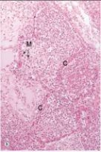 In the accompanying high power photomicrograph of lung,the alveoli shown are filled primarily with which one of the following cells?   A) Lymphocytes B) Neutrophils C) Eosinophils D) Macrophages E) Platelets