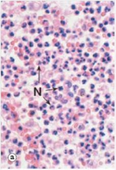 From analysis of the accompanying high power photomicrograph,how would you classify the acute inflammatory exudates seen?   A) Eosinophilic B) Fibrinous C) Fibrous D) Granulomatous E) Purulent