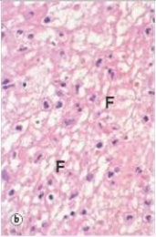 From analysis of the accompanying high power photograph,how would you classify the acute inflammatory exudates seen?   A) Eosinophilic B) Fibrinous C) Fibrous D) Granulomatous E) Purulent