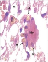 The brown pigment contained within the macrophages (M) shown in the accompanying high power photomicrograph of a myocardial infarction results from which one of the following physiologic processes?   A) Breakdown of haemoglobin B) Exogenous carbon deposition (anthracosis)  C) Macrophage apoptosis D) Melanocyte necrosis E) Oxidation of eosin dye