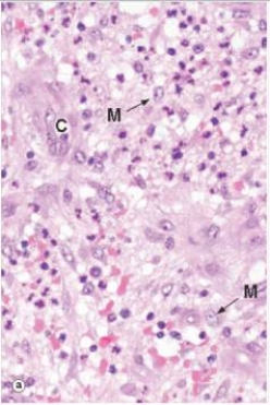The highly vascularised soft tissue shown in the accompanying high power photomicrograph is best described by which one of the following phrases?   A) Abscess B) Fibrinous exudate C) Fibrous granulation tissue D) Granuloma E) Granulomatous inflammation  F) Vascular granulation tissue