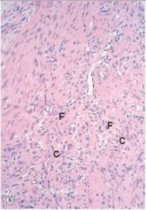 The healing soft tissue shown in the accompanying medium power photomicrograph is best described by which one of the following phrases?   A) Abscess B) Fibrinous exudate C) Fibrous granulation tissue D) Granuloma E) Granulomatous inflammation  F) Vascular granulation tissue