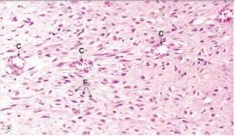 The healing soft tissue shown in the accompanying photomicrograph contains pink or hyalinised material interspersed between cell nuclei.Which one of the following words or phrases best describes the composition of this pink tissue?   A) Collagen B) Oedema C) Fibrin D) Necrotic tissue E) Protein
