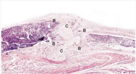 In the accompanying low power photomicrograph of a healing bone fracture,the tissue designated  C  is best described by which one of the following words or phrases?   A) Bone B) Callus C) Cartilage D) Chondrocytes E) Haematoma  F) Osteoid G) Scar