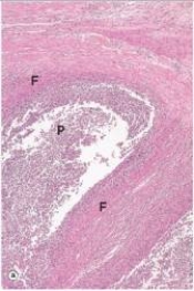 The structure labelled  F  in the accompanying photomicrograph of an acute abscess in the colon wall most likely consists of which one of the following substances or cells?   A) Collagen B) Complement C) Fibrin D) Fibroblasts E) Platelets