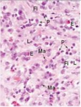 In the accompanying photomicrograph of healing soft tissue,the cells labelled  P  comprise which one of the following cell populations?   A) Eosinophils B) Fibroblasts C) Macrophages D) Neutrophils E) Plasma cells