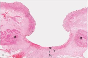 In the accompanying photomicrograph of a peptic ulcer,the tissue in the base of the ulcer labelled  Sl  is most likely to contain which one of the following materials or cell types?   A) Fibroblasts B) Gastric epithelium C) Necrotic cell debris and fibrin D) Neutrophils E) Pancreatic glands