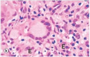 In the accompanying photomicrograph of a tuberculous granuloma,the multi-nucleated giant cell in the middle is derived from which one of the following cells?   A) Epithelioid macrophage B) Lymphocyte C) Neutrophil D) Plasma cell E) T cell