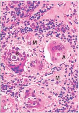 In the accompanying high power photomicrograph of a lymph node,taken from a patient with sarcoidosis,the multi-nucleated giant cell labelled  A  contains a characteristic inclusion body known as which one of the following?   A) Apoptotic body B) Asteroid body C) Eosinophilic body D) Negri body E) Schaumann body