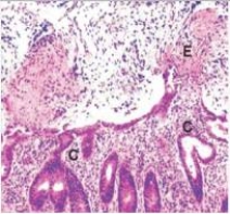 In the accompanying photomicrograph of colon,a fibrinous exudate (E) is seen erupting from the surface of the colonic mucosa.Which one of the following organisms characteristically causes such a microscopic picture?   A) Actinomyces israelii B) Clostridium difficile C) Mycobacterium tuberculosis D) Staphylococcus aureus E) Streptococcus pneumonia