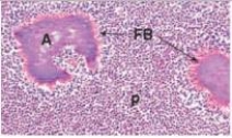 In the accompanying photomicrograph from a cervical (neck) lymph node,what is the proper terminology for the eosinophilic,proteinaceous halo (seen at the tip of the arrows) around colonies of Actinomyces organisms (labelled  A ) ?   A) Coagulation B) Necrosis C) Splendori-Hoeppli phenomenon D) Spock-Kirk continuum E) Trilaminar membrane