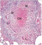 In the accompanying low power photomicrograph of lung from a patient with tuberculosis,the eosinophilic area labelled  CN  in the centre of the lesion depicted is best described by which one of the following words or statements?   A) Apoptosis B) Caseous necrosis C) Cottage cheese degeneration D) Liquifactive necrosis E) Suppurating granuloma