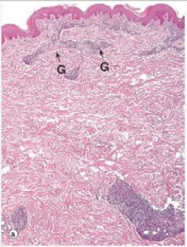 The accompanying low power photomicrograph of skin is from a person with leprosy.The areas labelled  G  are granulomas.Which one of the following words or phrases best describes the type of leprosy represented?   A) Biblical B) Complex C) Simple D) Lepromatous E) Tuberculoid