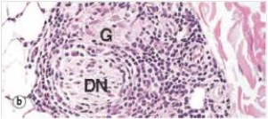 The accompanying high power photomicrograph of skin,showing a small dermal nerve (DN) is from a person with tuberculoid leprosy.The area labelled  G  is an associated granuloma.If an acid-fast stain were performed on this section,in an attempt to visualise the leprosy bacilli,which one of the following would you expect to see upon microscopic examination?   A) Few acid-fast organisms B) Large numbers of acid-fast organisms C) No organisms - acid-fast stains don't work for Mycobacterium leprae