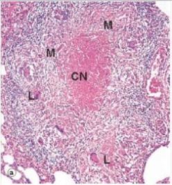 In the accompanying low power photomicrograph of lung tissue from a patient with tuberculosis,the large cells labelled with an  L  are best known by which one of the following terms?   A) Amoeba cells B) Astrocytes C) Langhans' giant cells D) Large cells E) Large lymphocytes