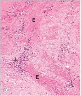 A 54 year old man presented at the Emergency Department with severe chest pain.A chest x-ray revealed a markedly dilated ascending aorta.Before any further tests could be performed,the patient expired.At autopsy,a markedly dilated aorta was observed,with aortic dissection.The accompanying photomicrograph shows the pathology of the aorta.The letter  E  denotes elastic fibres,while  L  shows a lymphoplasmacytic infiltrate around small vessels in the adventitia.Which one of the following is the best explanation for the underlying cause of the patient's demise?   A) Atherosclerosis B) Congenital elastin deficiency C) Endarteritis obliterans D) Marfan syndrome E) Myocardial infarction