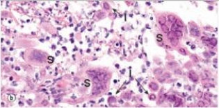The accompanying photomicrograph depicts an endoscopic biopsy of the oesophagus from a patient undergoing chemotherapy for gastric cancer.From the microscopic appearance of the syncytial cells (denoted with an  S ) ,which one of the following viruses is directly involved in this infection of the oesophagus?   A) Cytomegalovirus (CMV)  B) Human immunodeficiency virus (HIV)  C) Human papillomavirus (HPV)  D) Herpes simplex virus (HSV)  E) Measles virus