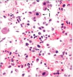 The accompanying photomicrograph depicts an endoscopic biopsy of lung tissue from a patient undergoing chemotherapy for leukaemia.The arrows point to cells with viral inclusion bodies.Which one of the following viruses is directly involved in this case of viral pneumonitis?   A) Cytomegalovirus (CMV)  B) Human immunodeficiency virus (HIV)  C) Human papillomavirus (HPV)  D) Herpes simplex virus (HSV)  E) Measles virus
