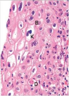 The accompanying photomicrograph depicts a biopsy of uterine cervix tissue from a 24 year old woman with an abnormal Pap smear.Which one of the following viruses is directly involved in this infection of the squamous mucosa of the cervix?   A) Cytomegalovirus (CMV)  B) Human immunodeficiency virus (HIV)  C) Human papillomavirus (HPV)  D) Herpes simplex virus (HSV)  E) Measles virus
