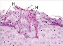 The accompanying high power photomicrograph shows a biopsy of the buccal mucosa from an immunocompetent patient who had been taking broad spectrum antibiotics.Which one of the following is the best diagnosis?   A) Aspergillosis B) Candida albicans C) Cryptococcus neoformans D) Herpes simplex virus E) Pneumocystis jirovecii  F) Zygomycosis (Mucormycosis) 