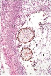 A 60 year old male was treated with chemotherapy for leukaemia.He developed wedge-shaped infiltrates in his lungs,one of which was biopsied.A representative section is shown in the accompanying photomicrograph.Which one of the following is the best diagnosis?   A) Candida albicans pneumonitis B) Cryptococcal pneumonia (Cryptococcus neoformans)  C) Cytomegalovirus (CMV) pneumonitis D) Disseminated aspergillosis E) Pneumocystis jirovecii pneumonitis