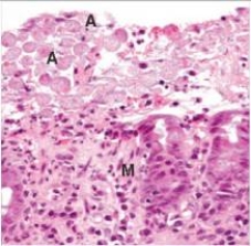 An otherwise well 43 year old man visited Mexico.He was well until he returned to the United States a few days later,whereupon he experienced bloody diarrhoea and crampy abdominal pain.Because of the possibility of parasitic infection,a colonic biopsy was performed.A representative section from the procedure is shown in the accompanying photomicrograph.Based upon the histopathologic findings,which one of the following is the best diagnosis?   A) Candida albicans B) Cytomegalovirus (CMV)  C) Entamoeba histolytica D) Giardia lamblia E) Trichomonas vaginalis