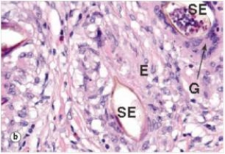 A 22 year old woman volunteered for a medical mission in Egypt.Before she returned to the United States,she wanted to swim in a tributary of the famous Nile River.This she did,but,after her return,she noted pain in the suprapubic area and bloody urine.A biopsy of the bladder was done,revealing the findings shown in the accompanying high power photomicrograph.The structure marked  SE  is virtually pathognomonic for the disorder,which is which one of the following infections?   A) Entamoeba histolytica B) Giardia lamblia C) Plasmodium falciparum D) Schistosoma haematobium E) Trichomonas vaginalis