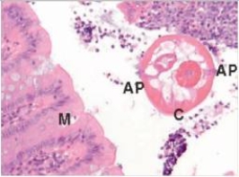 A 6 year old boy was brought to the Emergency Department by his mother because of increasing pain in the right lower abdomen.A diagnosis of appendicitis was made,and the appendix was removed laparoscopically.A representative section of the appendix is shown in the accompanying high power photomicrograph.Which one of the following is the best diagnosis of the cause of the boy's appendicitis?   A) Entamoeba histolytica B) Enterobius vermicularis C) Giardia lamblia D) Schistosoma haematobium E) Trichomonas vaginalis