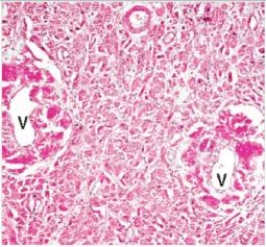 A 37 year old woman died of congestive heart failure.An autopsy was requested by the family because her sister had also died at a young age of congestive heart failure.At autopsy,the heart was enlarged,and had a waxy,pale appearance.A representative section is shown in the accompanying photomicrograph.Which one of the following is the best diagnosis?   A) Localised senile amyloid B) Systemic heredofamilial amyloidosis C) Systemic amyloidosis due to multiple myeloma D) Systemic senile amyloidosis