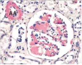 A 58 year old woman was seen by a nephrologist for chronic renal failure.She had a 20 year history of rheumatoid arthritis.A renal biopsy was performed,and a representative glomerulus is shown in the accompanying photomicrograph,stained with Sirius Red.Which one of the following is the best diagnosis for the cause of her renal failure?   A) Acute glomerulonephritis B) Diabetic glomerulosclerosis C) Systemic amyloidosis D) Systemic hypertension