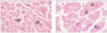 Normal myocardium is shown in the left hand panel of the accompanying photomicrograph,whereas the right hand panel shows abnormal myocardium.Which one of the following is the most likely pathophysiologic explanation for the changes seen in the myocardium on the right?   A) Acute inflammation,due to myocardial infarction B) Ageing C) Cancer of the myocardium D) Increased number of cells E) Increased synthesis of proteins and intermediate filaments