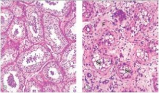 Normal testis tissue is shown in the left hand panel of the accompanying photomicrograph,whereas the right hand panel shows abnormal testis.Which one of the following is the most likely pathophysiologic explanation for the changes seen in the testis on the right?   A) Acute inflammation B) Ageing C) Cancer of the testis (seminoma)  D) Increased number of cells E) Increased synthesis of proteins and intermediate filaments