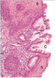 A 54 year old man had been experiencing heartburn for a number of years.His physician eventually decided to recommend upper GI endoscopy.A mid-oesophagus biopsy sample is shown in the accompanying photomicrograph.Which one of the following is the best diagnosis?   A) Acute inflammation B) Barrett's oesophagus C) Colonic hyperplasia D) Gastric hypertrophy E) Giardia lamblia infection
