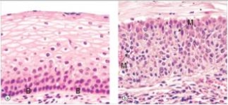 A 24 year old woman underwent biopsy of the uterine cervix because of an abnormal Pap smear.A representative section of the biopsy is shown in panel  b  of the accompanying photomicrograph.Panel  a  is a normal uterine cervix for comparison.Which one of the following is the best diagnosis?   A) Invasive squamous cell carcinoma B) Squamous cell atrophy C) Squamous cell dysplasia D) Squamous cell hyperplasia E) Squamous cell metaplasia