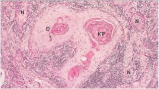 A 67 year old woman was found to have metastatic nodules in her lung upon routine chest x-ray.A thoracoscopic biopsy of one of these nodules disclosed the histology seen in the accompanying photomicrograph.Which one of the following tissues is the most likely source for the metastatic neoplasm?   A) Bladder B) Breast C) Colonic mucosa D) Oesophagus E) Pancreas