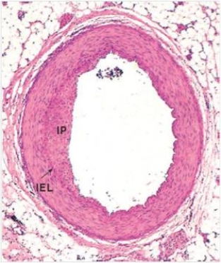 In the accompanying photomicrograph of a small artery,the abnormality labelled  IP  refers to which one of the following?   A) Iconographic proliferation B) Idiopathic protein C) Initial peninsula D) Intimal proliferation E) Ischemic portion