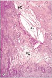 A high power view of an arterial wall is shown in the accompanying photomicrograph.In the portion of the field labelled  C ,which one of the following is responsible for the elongated,empty spaces seen?   A) Coagulative necrosis B) Cholesterol crystals C) Liquifactive necrosis D) Technical error E) Uric acid crystals