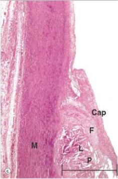 A high power view of an arterial wall is shown in the accompanying photomicrograph.Which one of the following words or statements is the best classification of the atheromatous plaque shown?   A) Fatty streak B) Fibrofatty plaque C) Fibrous plaque D) Intimal proliferation E) Necrotic plaque