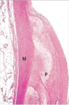 A high power view of an arterial wall is shown in the accompanying photomicrograph.Which one of the following words or statements is the best classification of the atheromatous plaque shown?   A) Fatty streak B) Fibrofatty plaque C) Fibrous plaque D) Intimal proliferation E) Necrotic plaque