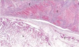 A high power view of an arterial wall is shown in the accompanying photomicrograph.The area labelled  T  is best described by which one of the following words or phrases?   A) Acute inflammation B) Cholesterol crystals C) Fibrofatty plaque D) Intimal proliferation E) Thrombus